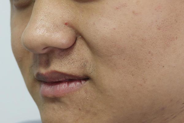 年纪不大鼻毛却变白了,通常和什么有关?提醒:不要用手拔