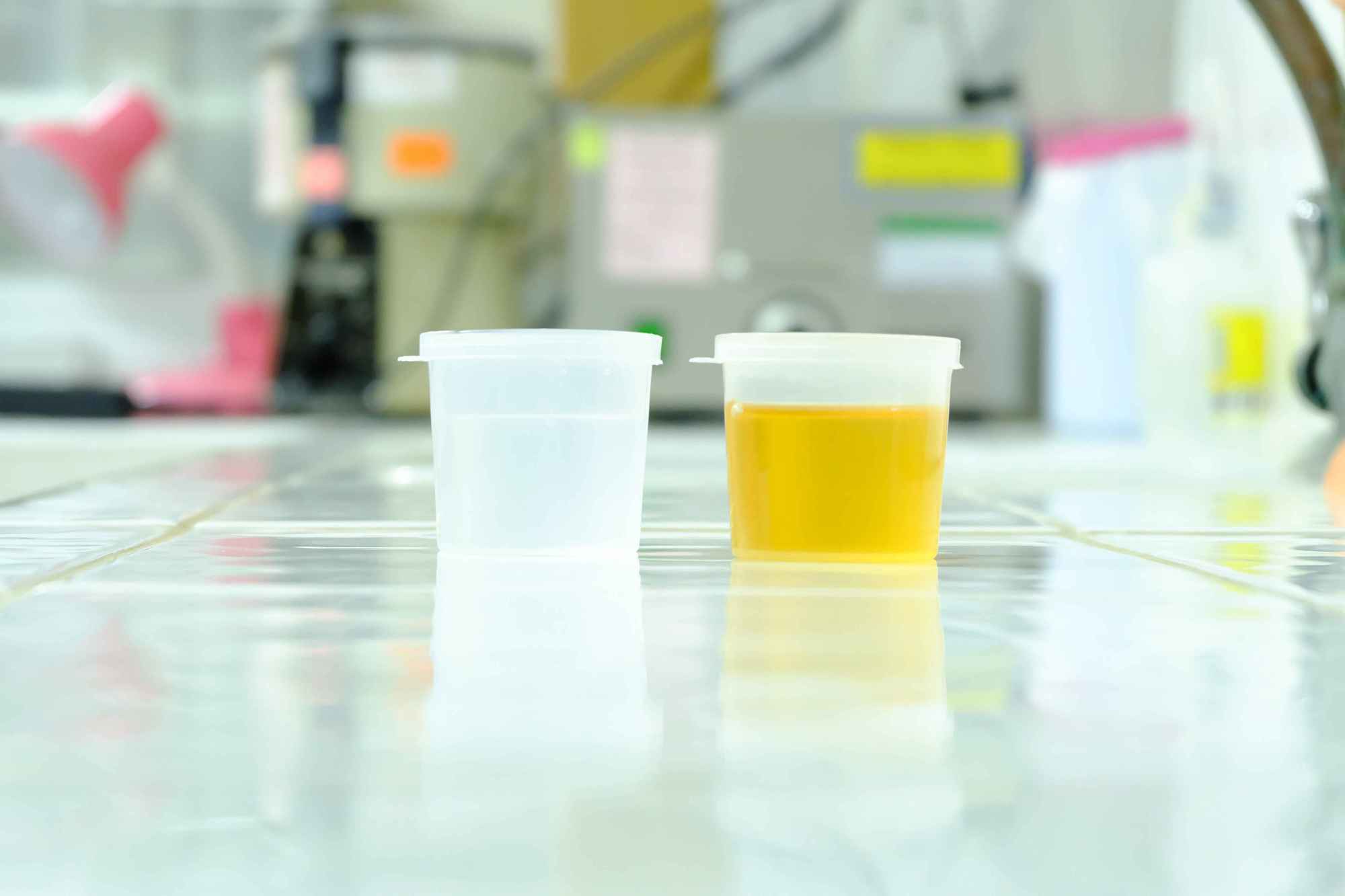 早上起床第一泡尿出现这3个特征,暗示肝不太好,要勤于养肝