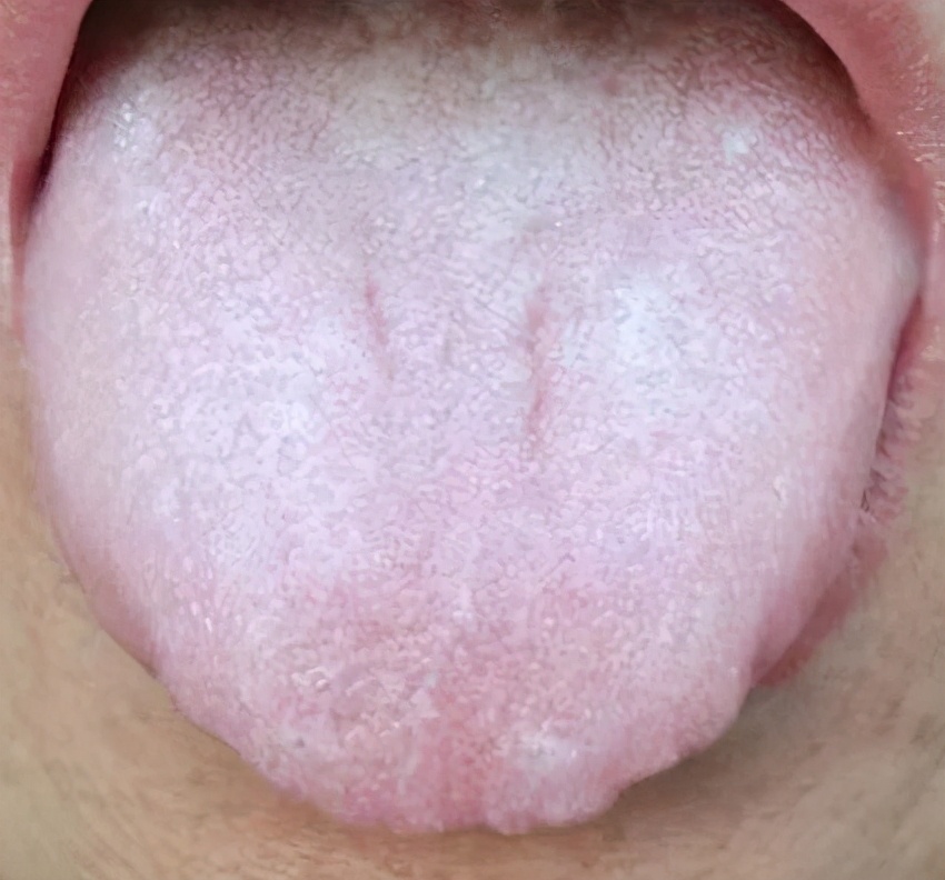 经常头晕、头脑昏沉?问题在脾,4个健脾祛湿方,帮你一招搞定