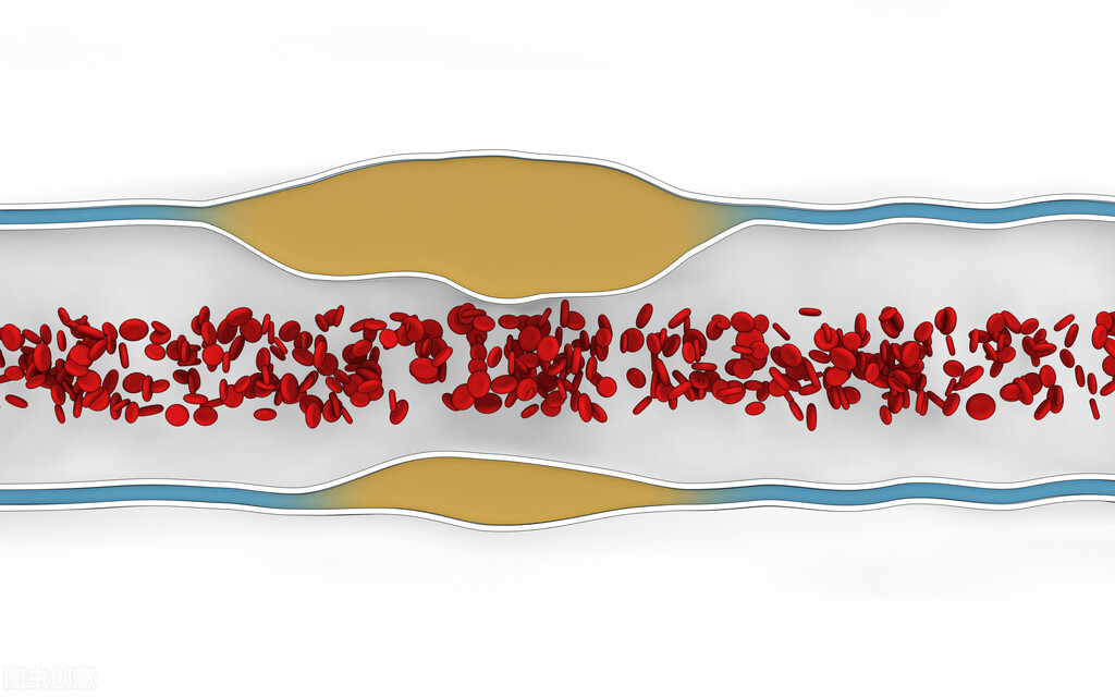 血管硬化之后还能软回去吗？与其想软化，不如做好5件事来预防