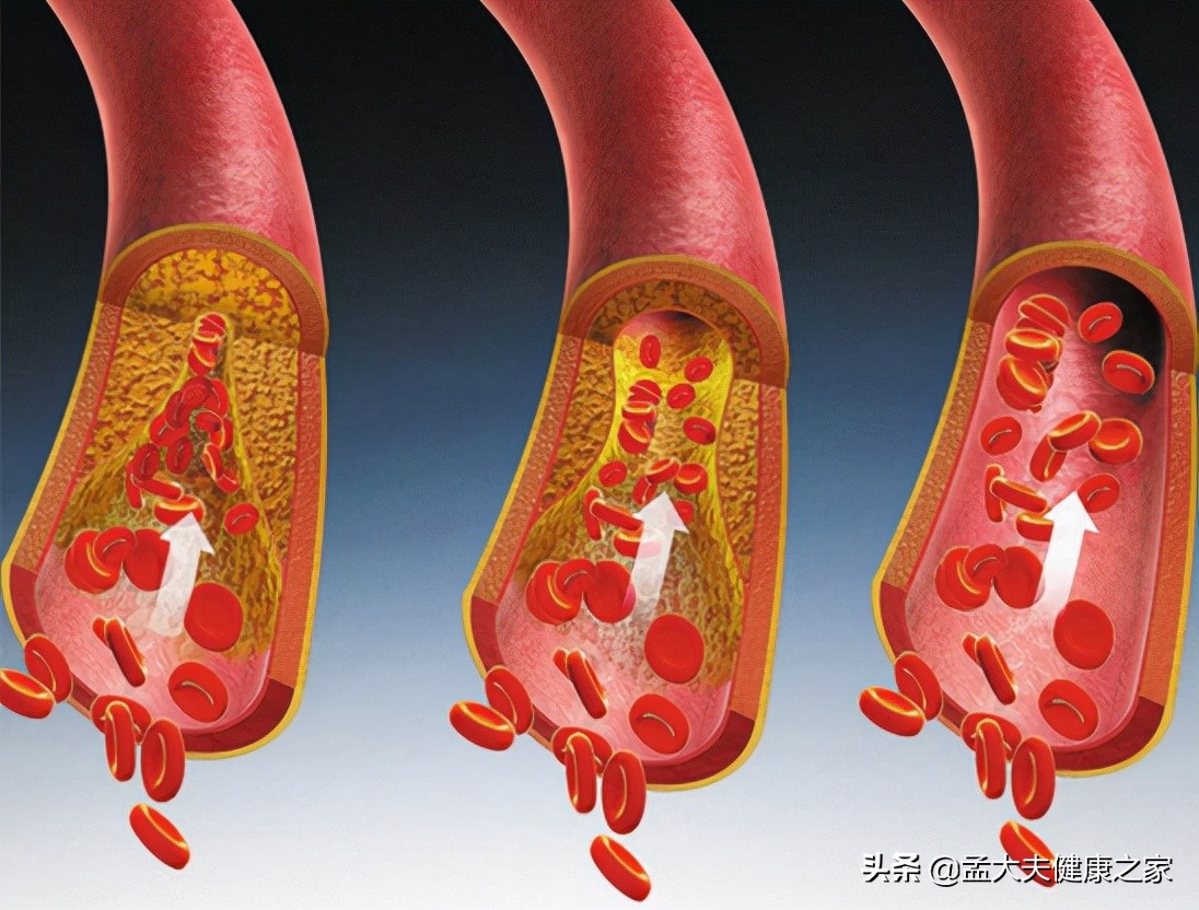 人到中年，为什么好好的血管，说堵就堵