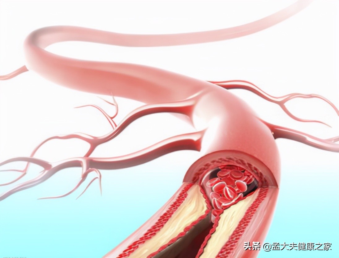 人到中年，为什么好好的血管，说堵就堵